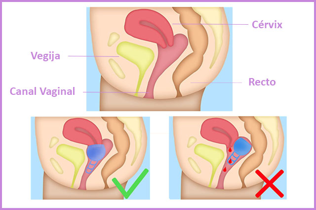 A qué altura colocar la Copa Menstrual